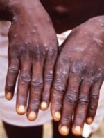 السودان يعلن رفع درجة الاستعداد لتصدي لـجدري القردة