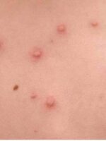 New case of monkeypox in West Darfur