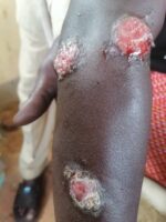 Emergence of skin allergy that causes wounds in the body in the locality of Radom