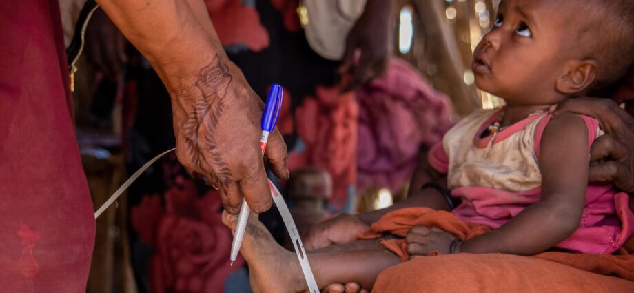 سوء التغذية