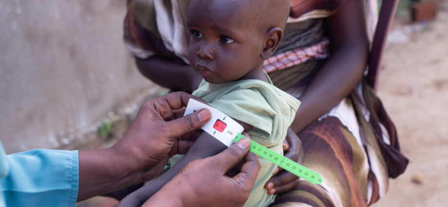 سوء التغذية